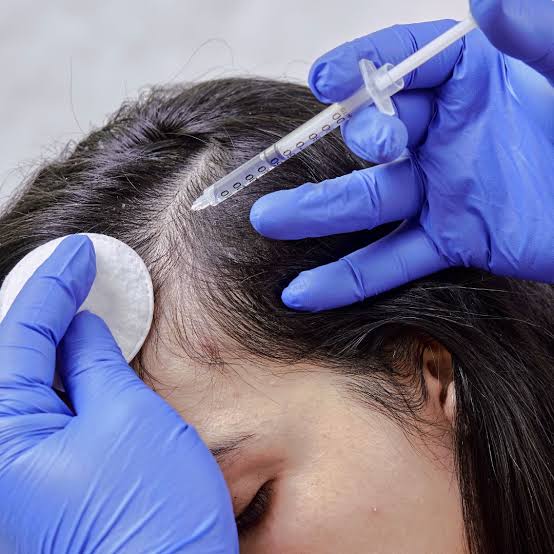 Illustrative photograph of mesotherapy on the scalp.