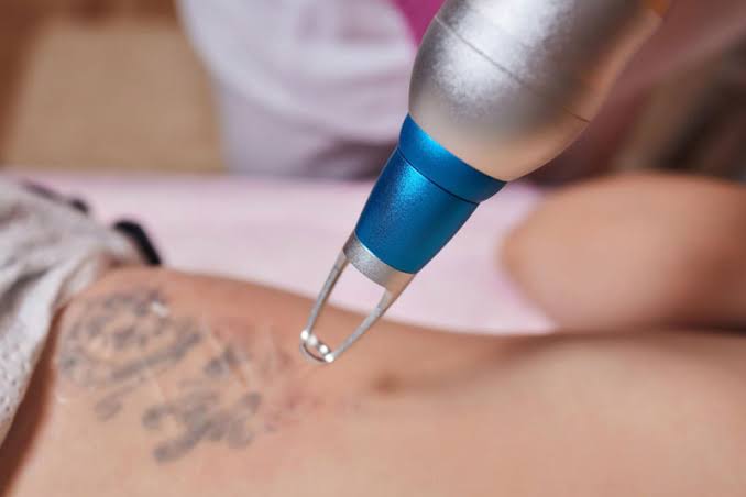 Illustrative photograph of a laser over a tattoo.